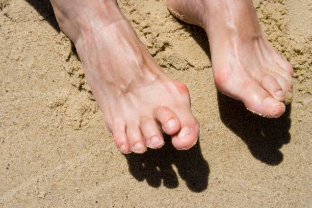 Recognizing Early Signs of Bunions: Prevention, Detection, and Treatment Options